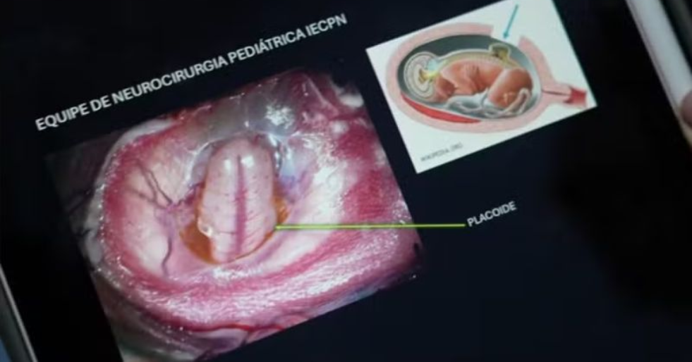 Cirurgia do SUS corrige coluna de bebê antes de nascer, com útero retirado e devolvido