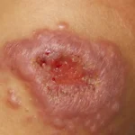 Esporotricose