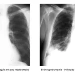 resumo de pneumonia