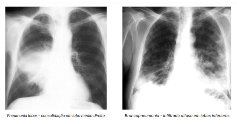 resumo de pneumonia