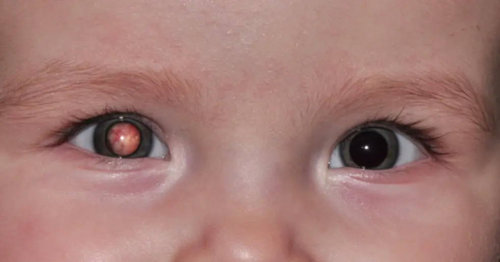 Resumo médico retinoblastoma